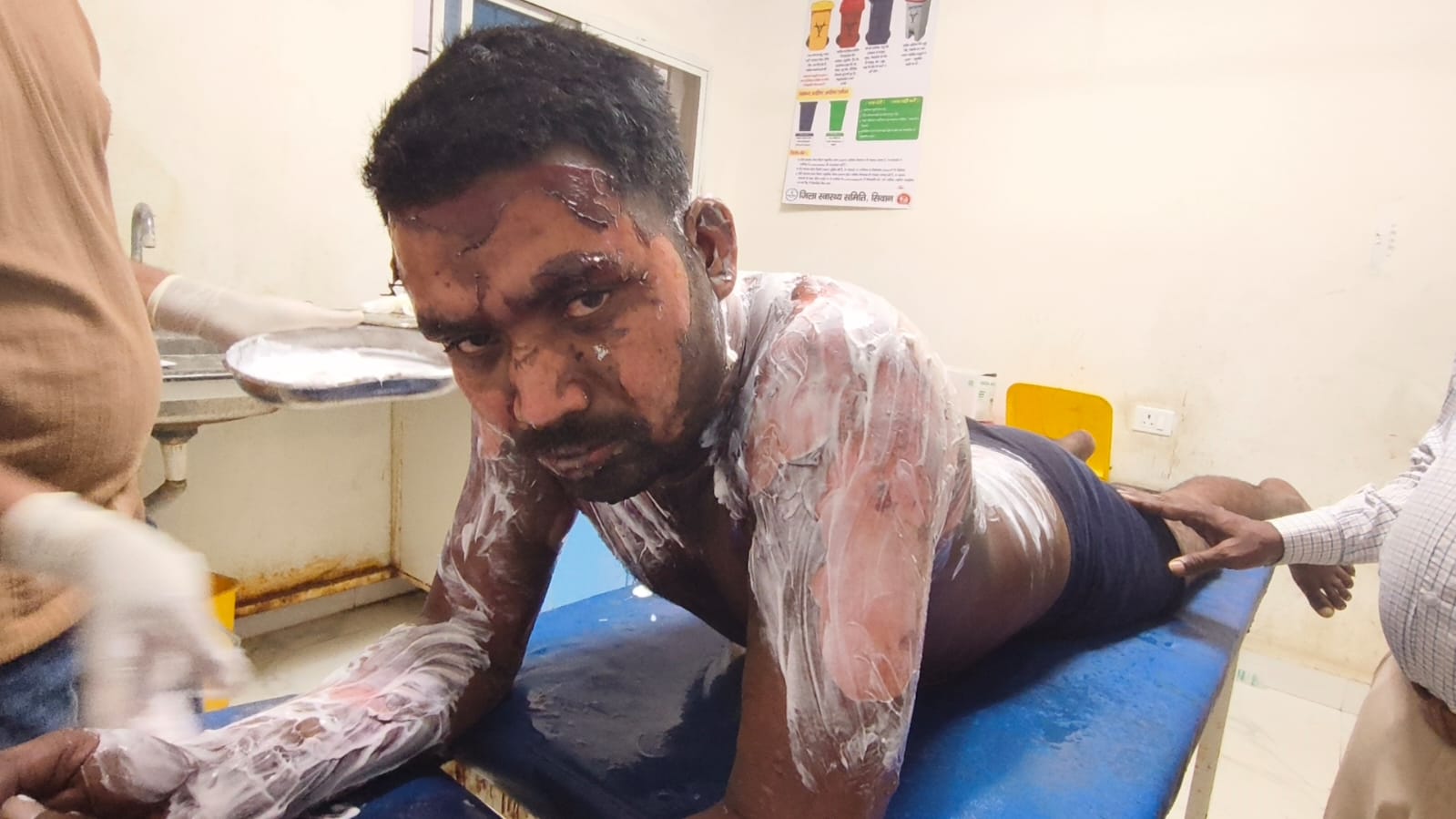 ससुराल बुलाकर युवक को जिंदा जलाने की कोशिश, आधी रात बना खौफ का मंजर